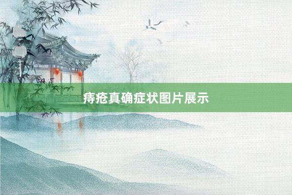 痔疮真确症状图片展示